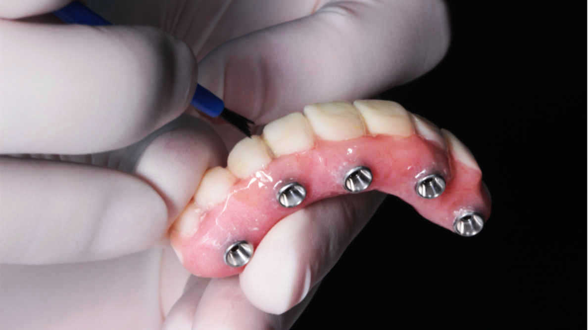 Review recommends tooth- and implant-supported fixed dental prostheses-Shenzhen  LJ Dental Laboratory Co., Ltd